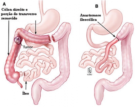 Intestino grosso (reto e clon)