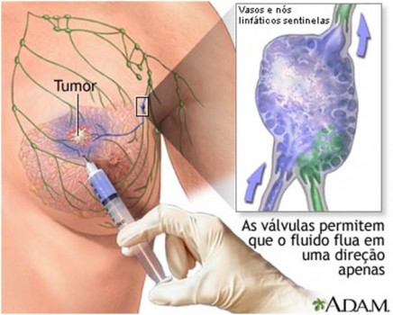 Linfonodo sentinela